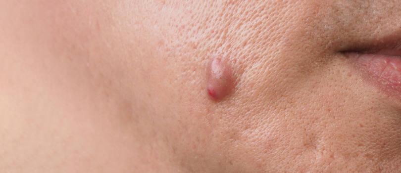 Lazer ile Ben ve Siğil Alımı