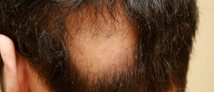 Alopecia Areata (Spot Baldness)