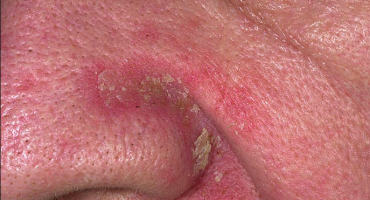 Seborrheic Eczema