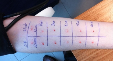 Allergic Skin Diseases and Allergy Tests