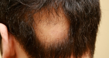 Alopecia Areata (Spot Baldness)
